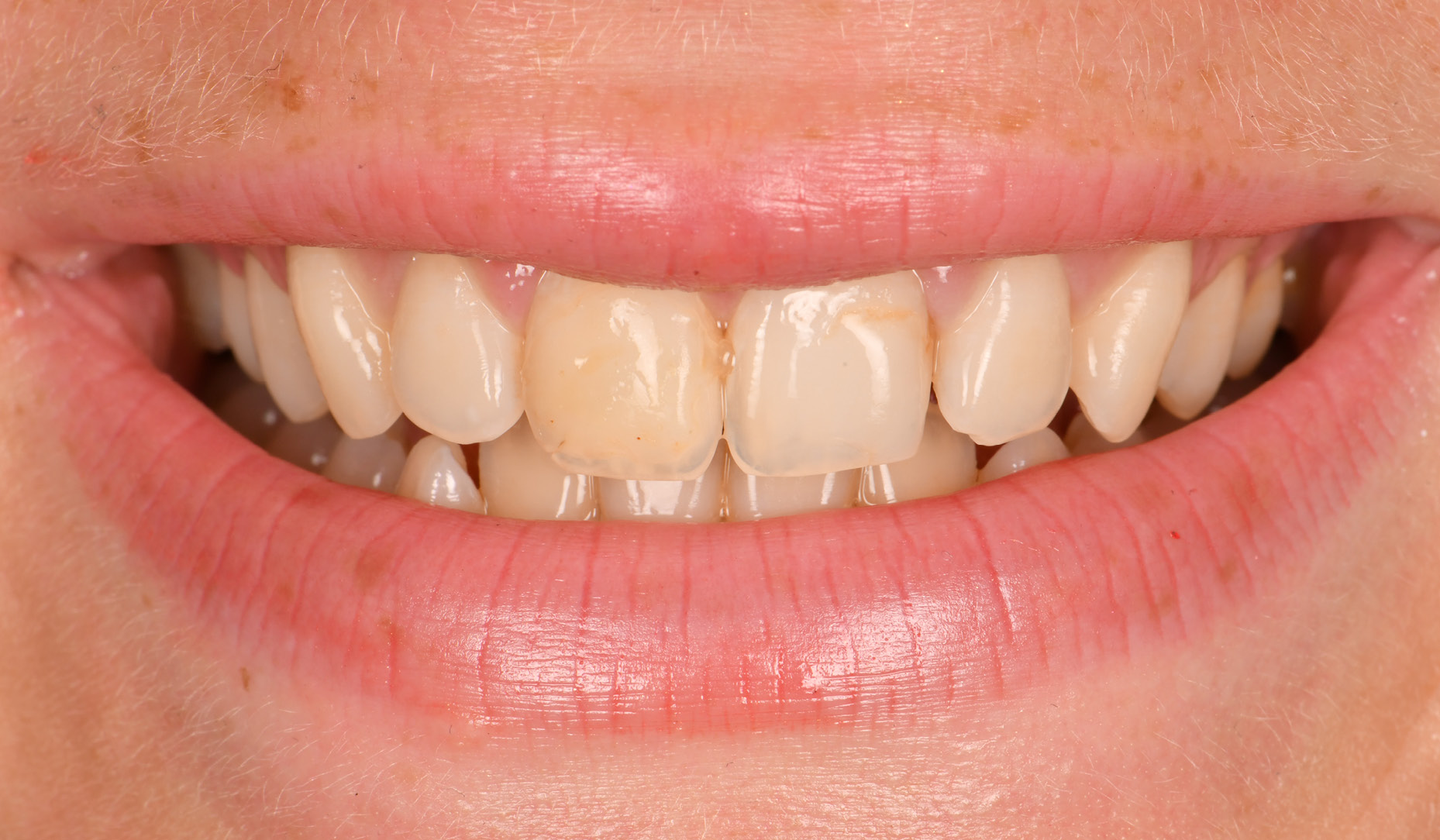 Figure 1: CLEARFIL&trade; Universal Bond Quick establishes a strong bond to dentin, enamel or old composite.